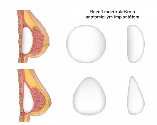 kulatý VS anatomický implantát, umělá prsa