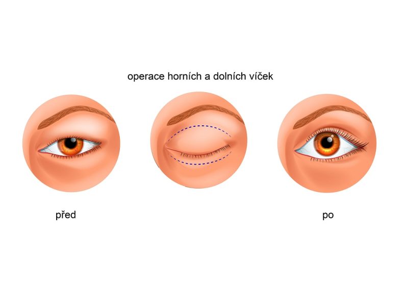Operace očních víček - horních i dolních
