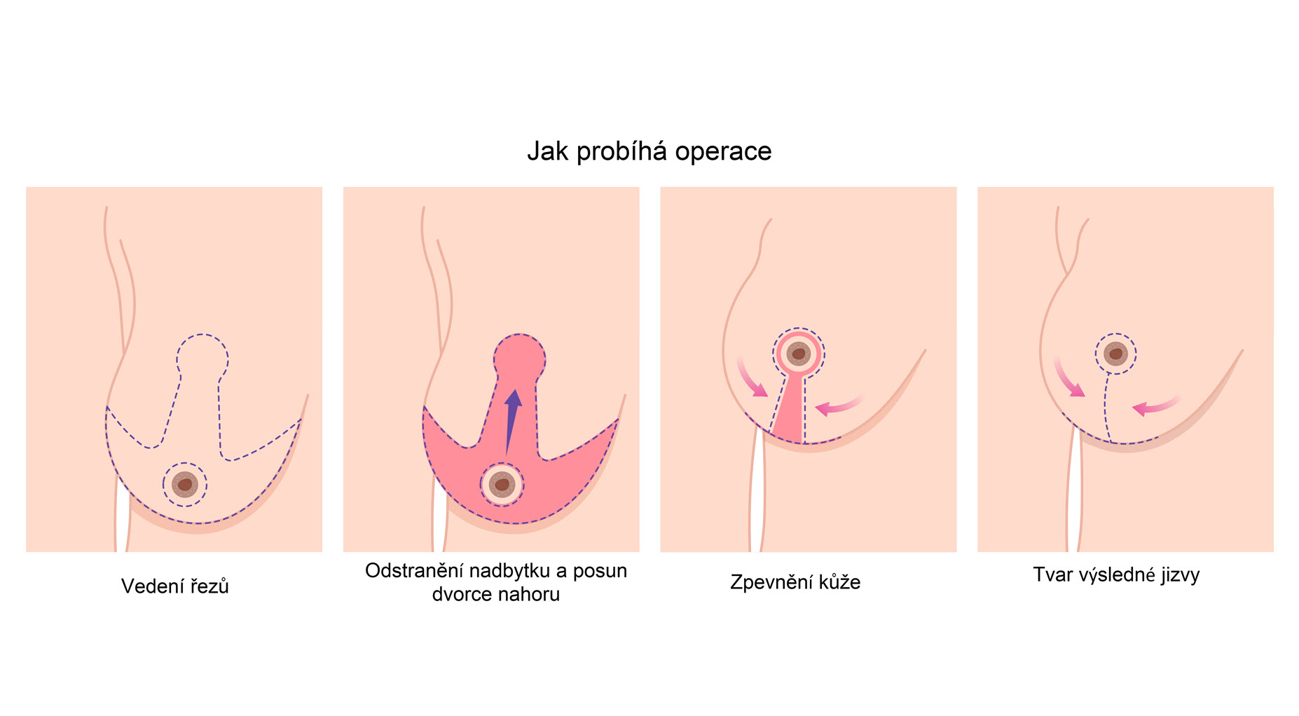 zmenšení prsou - jak probíhá operace, modelace prsou