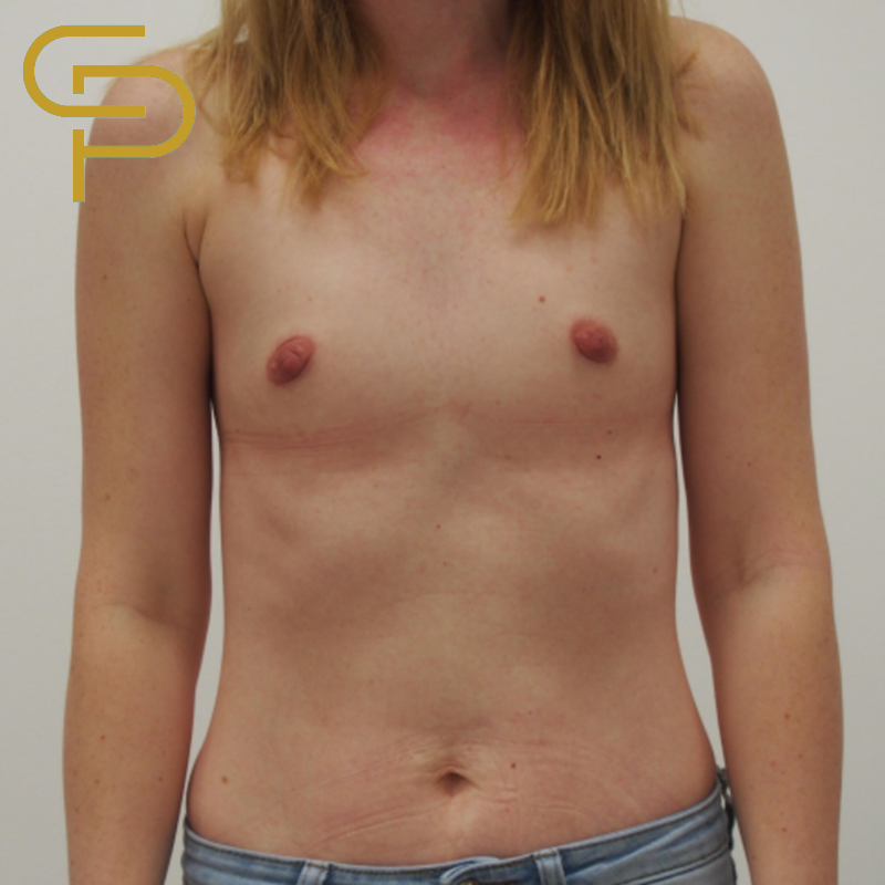 Augmentace prsou, kulatý polyuretanový odlehčený implantát 305ml