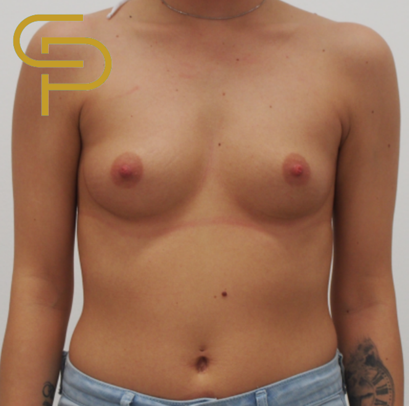 Augmentace prsou anatomickým polyuretanovým implantátem pod sval, 235ml
