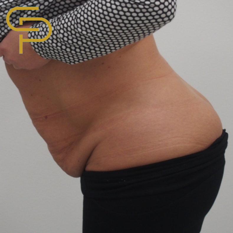 Abdominoplastika se zpevněním břišních svalů a liposukcí