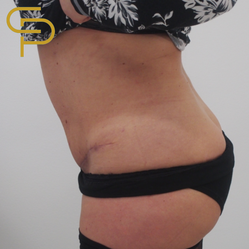 Abdominoplastika se zpevněním břišních svalů a liposukcí