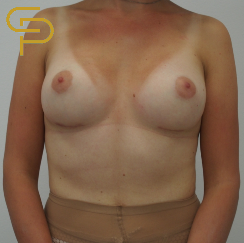 Augmentace prsou anatomickým polyuretanovým