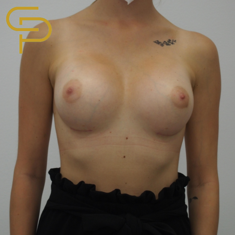 Augmentace prsou kulatým polyuretanovým a odlehčeným implantátem 365ml, pod žlázu