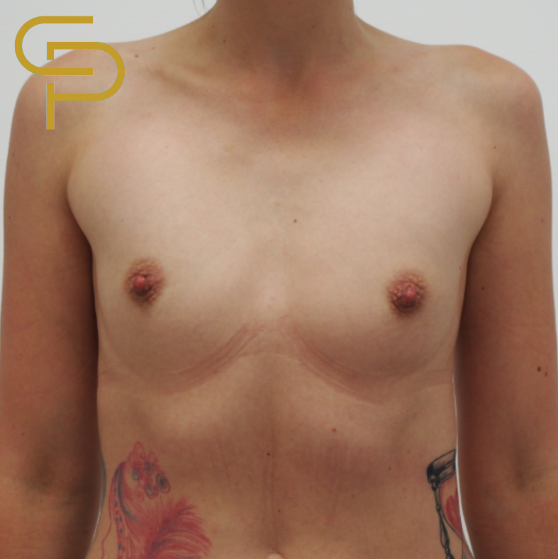 Augmentace prsou anatomickým polyuretanovým implantátem 290ml, pod sval