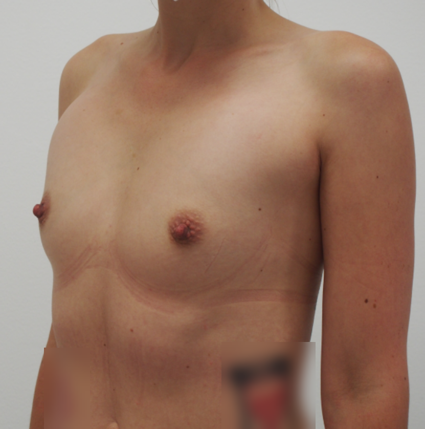 Augmentace prsou anatomickým polyuretanovým implantátem 290ml, pod sval