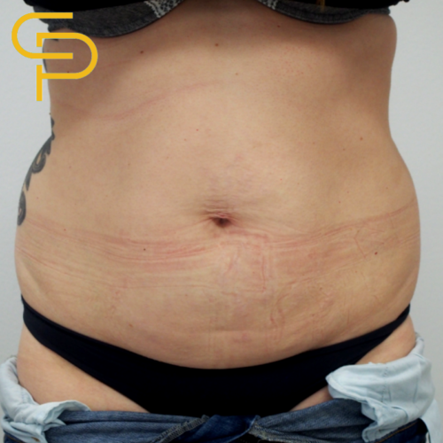 Liposukce břicha, boků a oblasti kříže