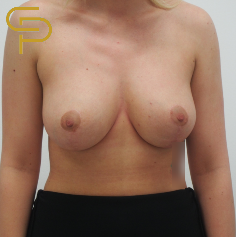 Modelace prsou se současnou augmentací vlastním tukem