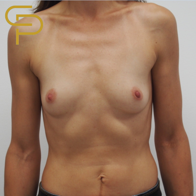 Augmentace prsou anatomickým polyuretanovým implantátem 260ml pod sval