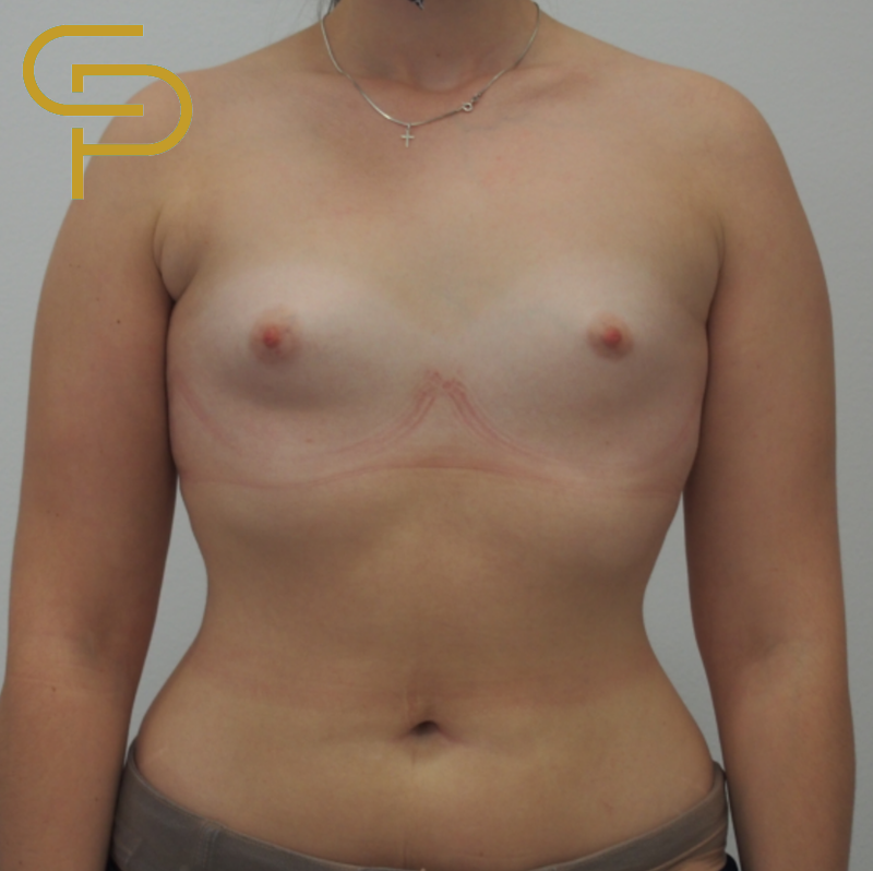 Augmentace prsou anatomickým polyuretanovým implantátem 320ml pod žlázu