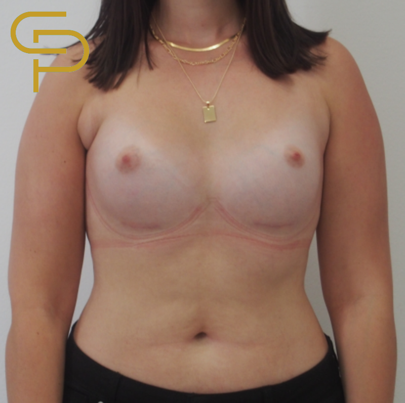 Augmentace prsou anatomickým polyuretanovým implantátem 320ml pod žlázu