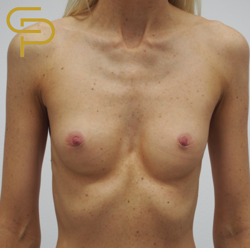 Augmentace prsou, kulatý polyuretanový implantát 285ml pod sval