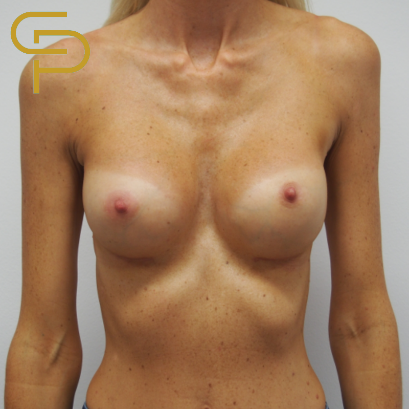 Augmentace prsou, kulatý polyuretanový implantát 285ml pod sval
