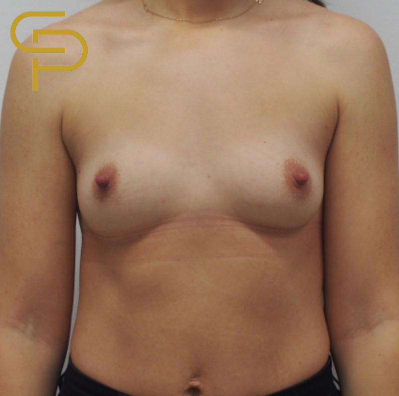 Augmentace prsou anatomickým polyuretanovým implantátem 315ml pod sval