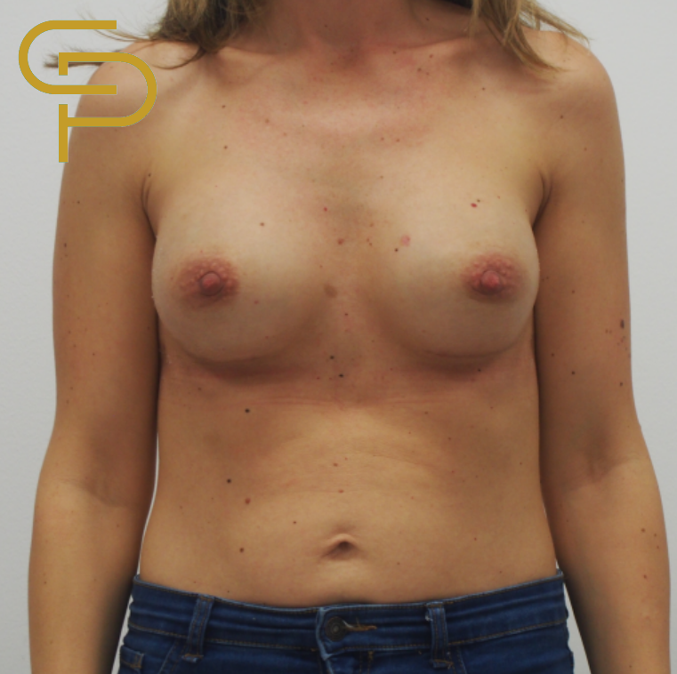 Augmentace prsou anatomickým polyuretanovám implantátem 260ml, pod sval