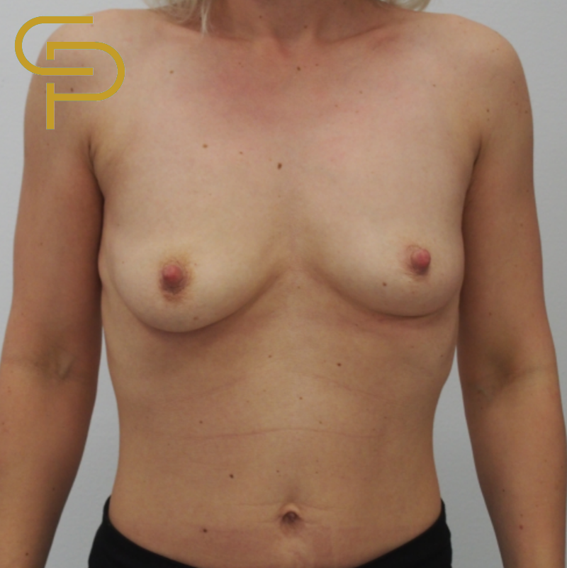 Augmentace prsou s modelací, implantát anatomický polyuretanový 365ml pod sval