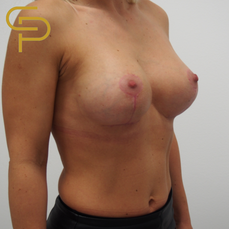 Augmentace prsou s modelací, implantát anatomický polyuretanový 365ml pod sval