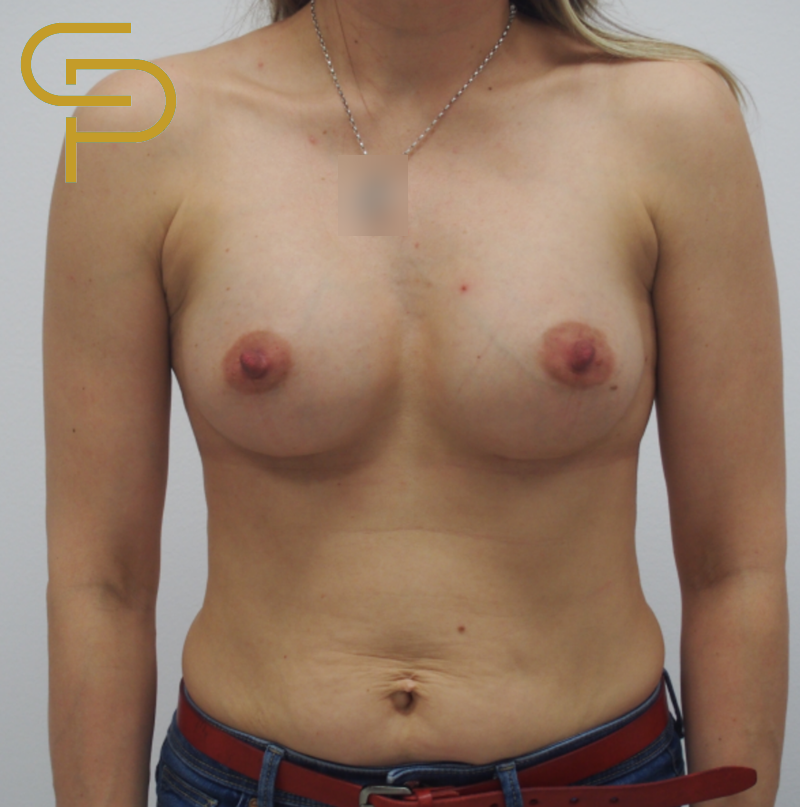 Augmentace prsou anatomickým polyuretanovým implantátem 290ml pod sval