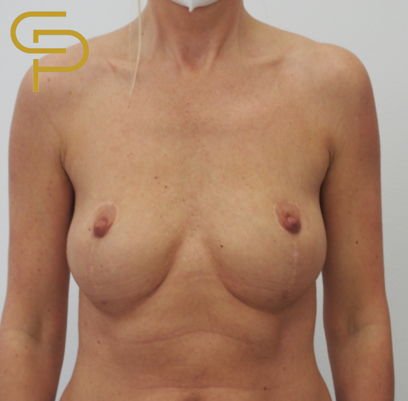 Augmentace prsou s vnitřní modelací polyuretanovým, odlehčeným anatomickým implantátem 325ml, korekce bottoming out deformity po dřívější modelací prsou