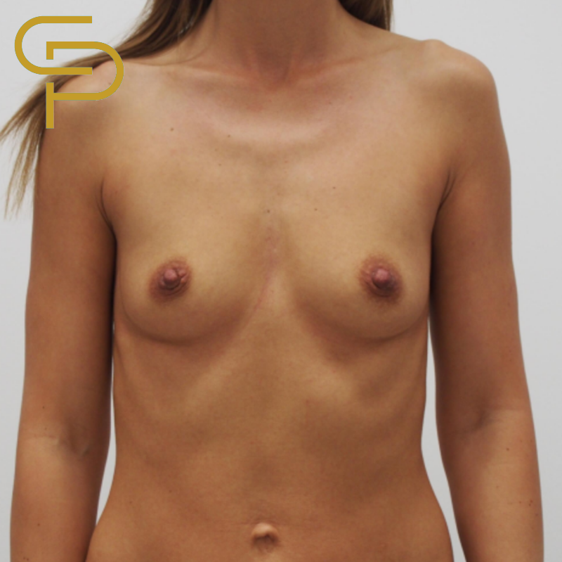 Augmentace prsou, anatomický polyuretanový implantát 285ml pod sval