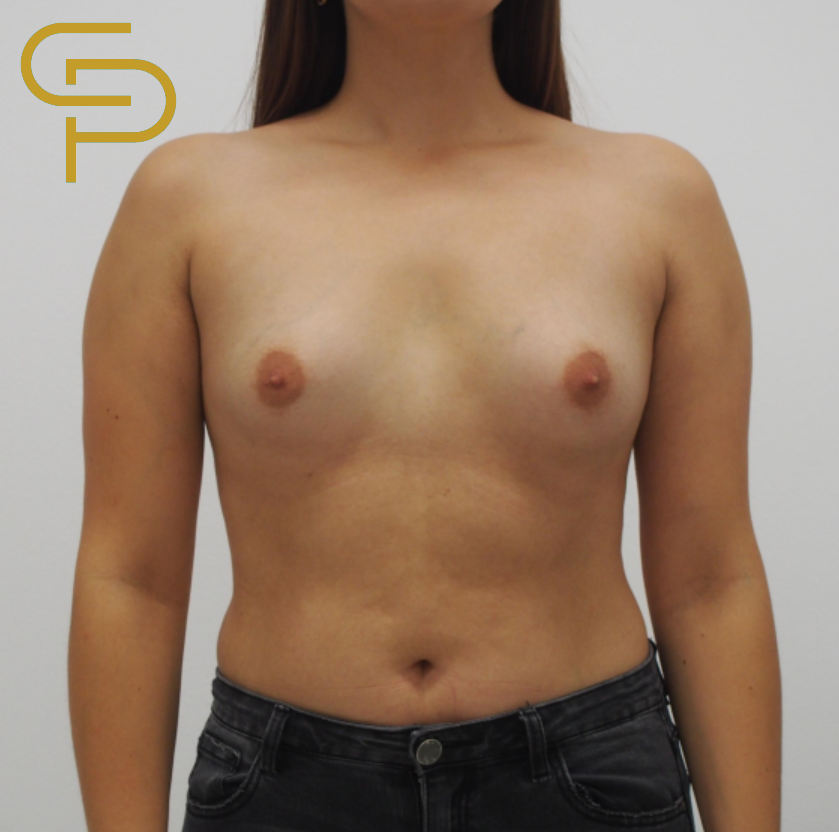 Augmentace tuberózních prsou, implantáty pod žlázu, různé velikosti
