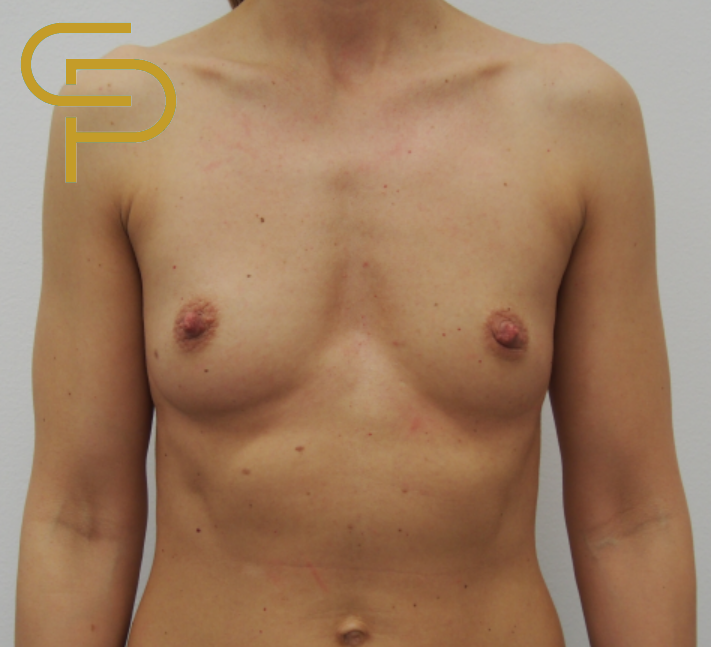 Augmentace prsou anatomickým polyuretanovým implantátem 285ml, pod sval