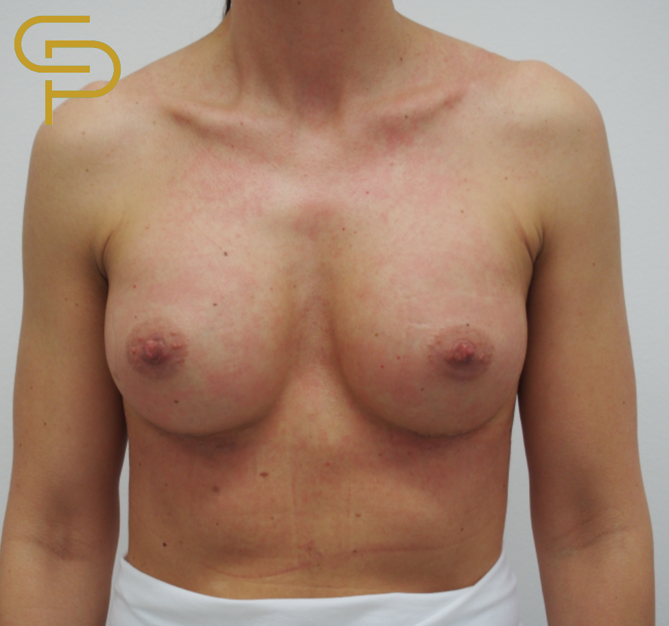 Augmentace prsou anatomickým polyuretanovým implantátem 285ml, pod sval