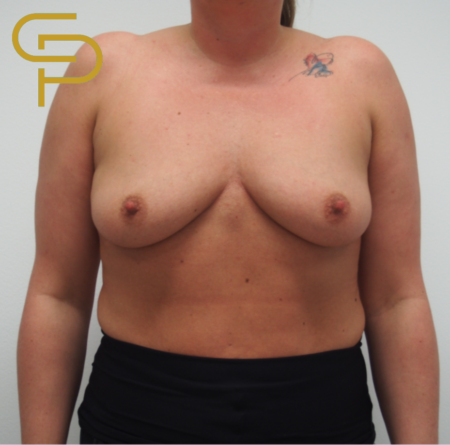 Augmentace prsou anatomickým polyuretanovým, odlehčeným implantátem 420ml pod žlázu