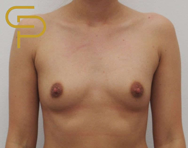 Augmentace prsou polyuretanovým implantátem pod sval, 315ml