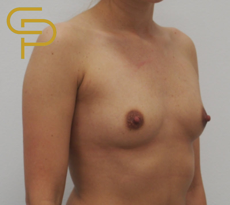 Augmentace prsou polyuretanovým implantátem pod sval, 315ml