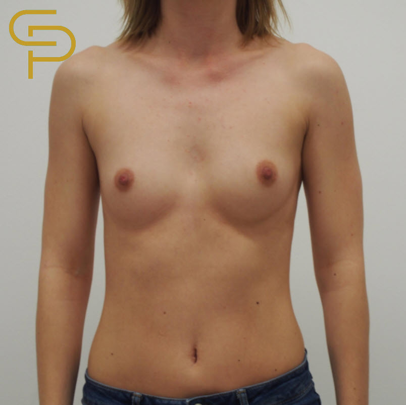 Augmentace prsou klasickým kulatým implantátem 285ml, pod sval