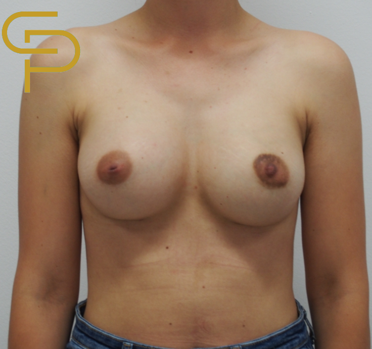 Augmentace prsou polyuretanovým implantátem 285ml pod sval