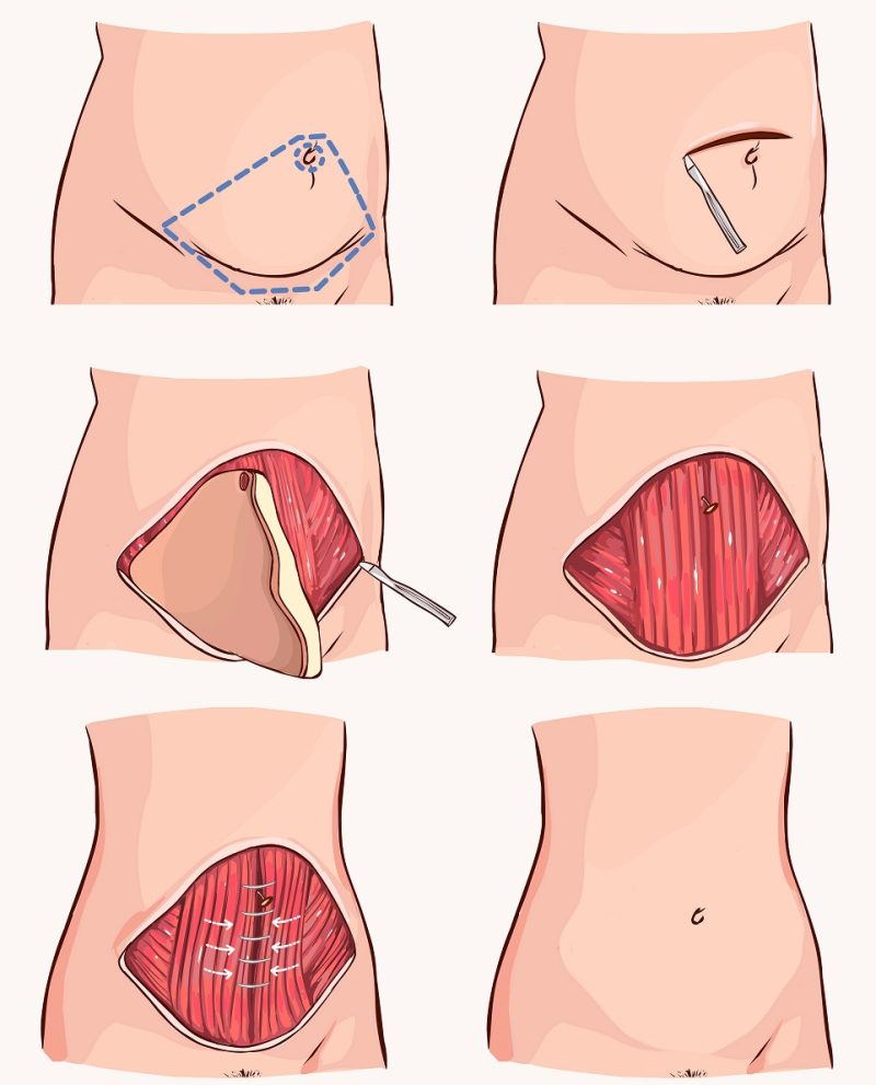 Abdominoplastika - průběh operace