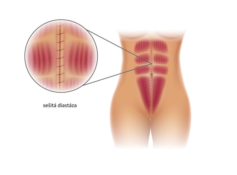 Diastáza břišních svalů po sešití