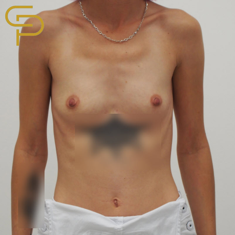 Augmentace prsou, Anatomický polyuretanový implantát 235ml pod sval