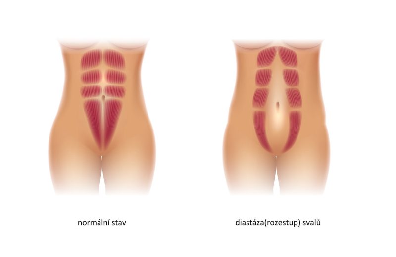 Typy diastázy břišních svalů