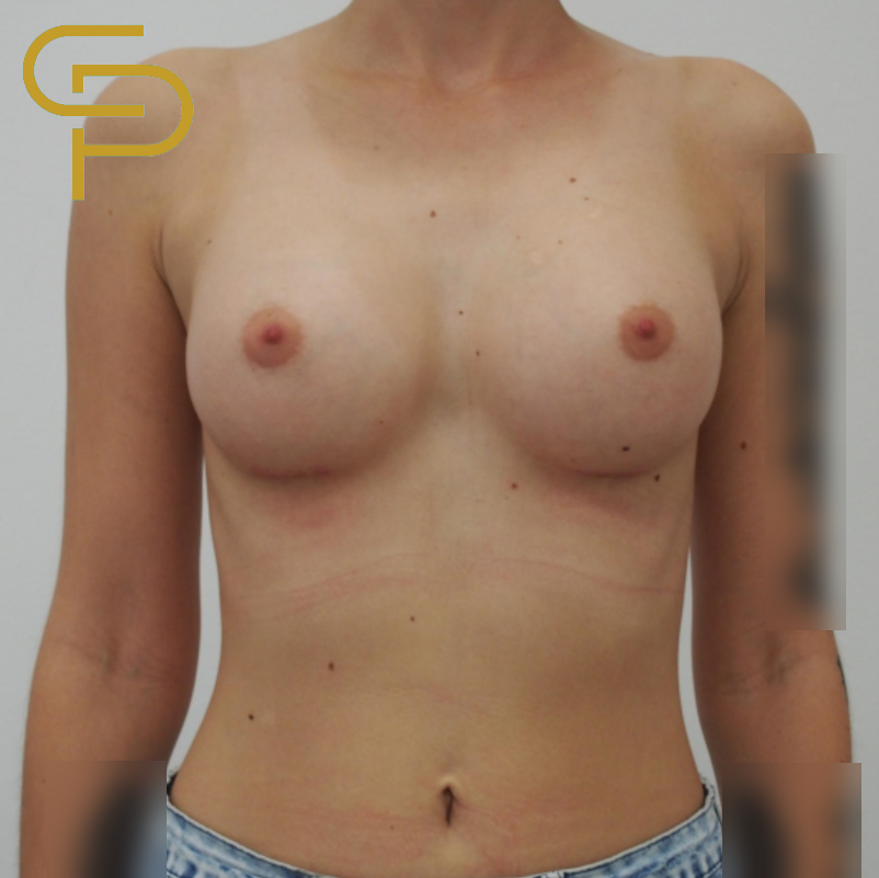 Augmentace prsou anatomickým polyuretanovým implantátem, pooperační foto