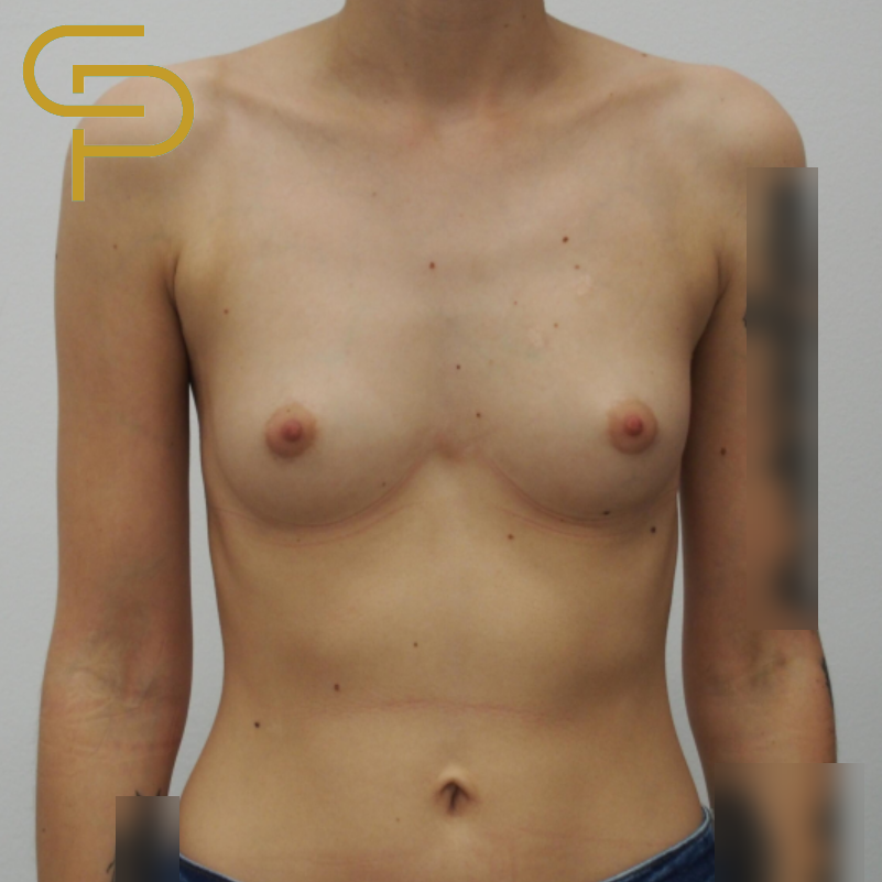 Augmentace prsou anatomickým polyuretanovým implantátem, předoperační foto