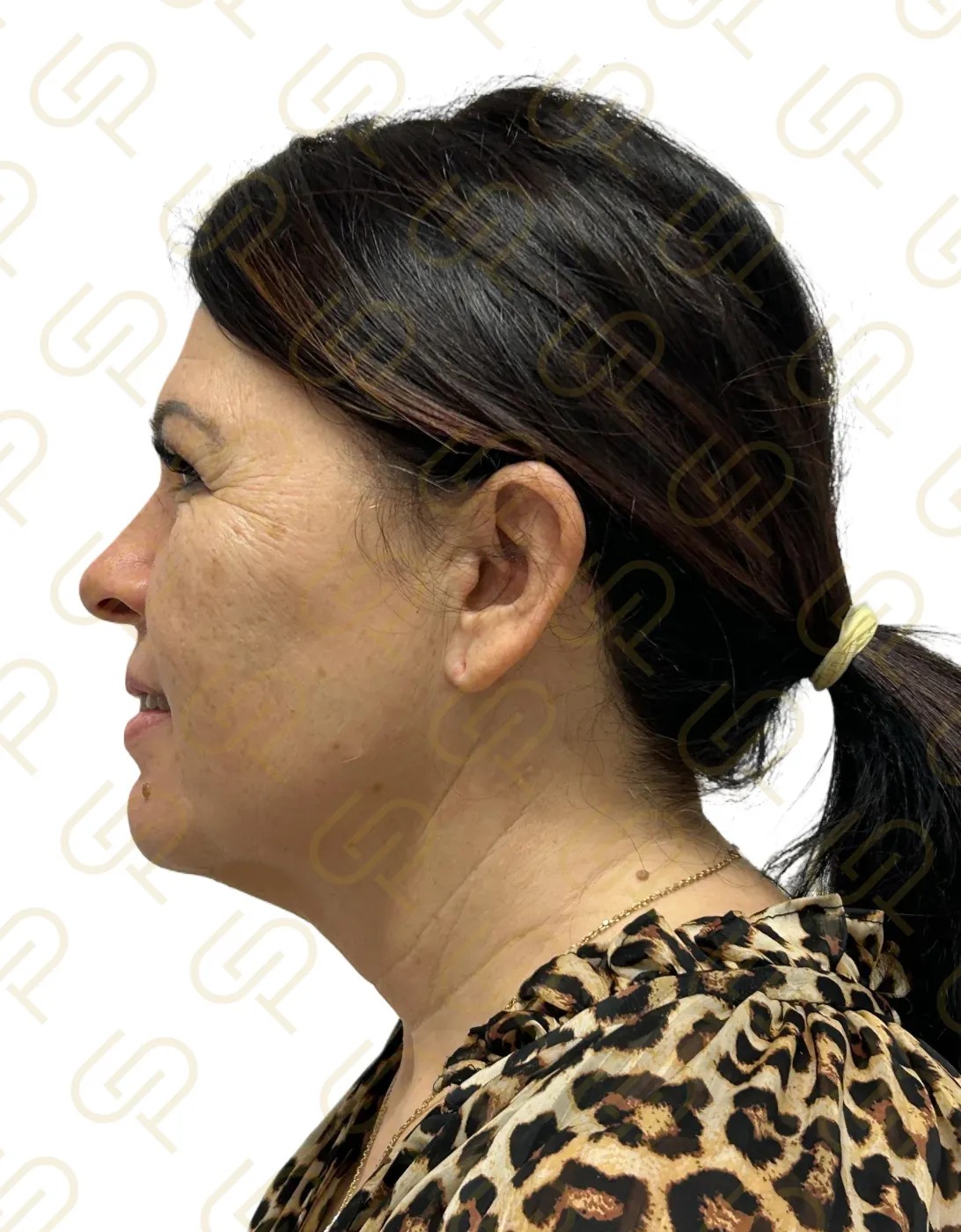 Deep facelift a deep necklift - dramatická konturace krku
