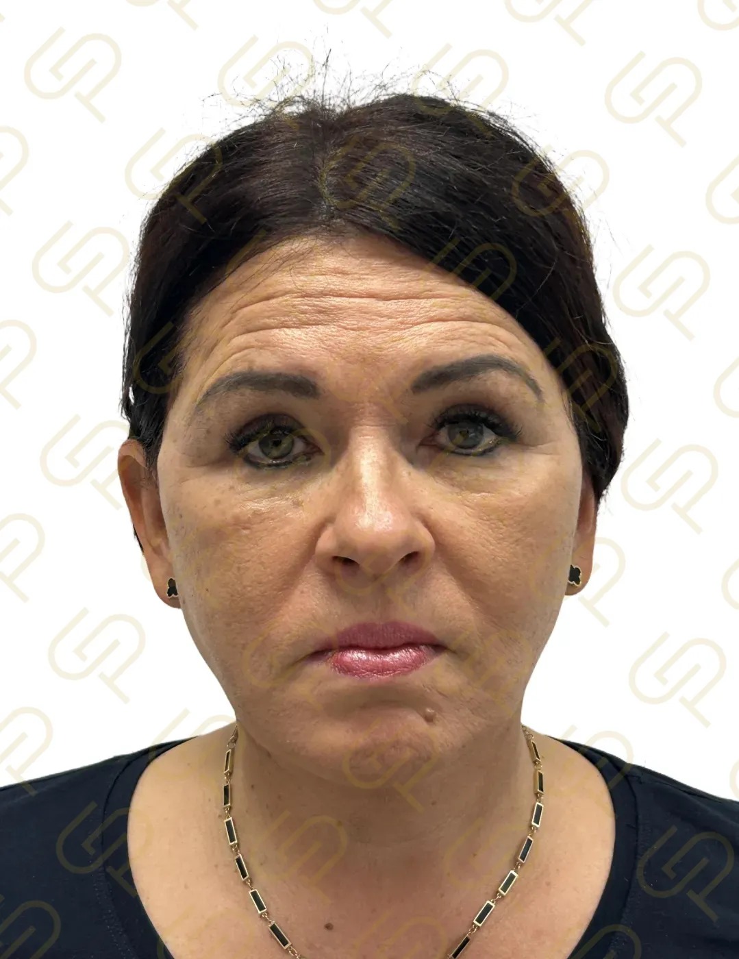 Deep facelift a deep necklift - dramatická konturace krku