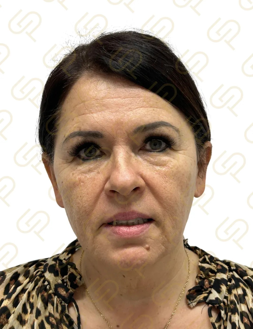 Deep facelift a deep necklift - dramatická konturace krku