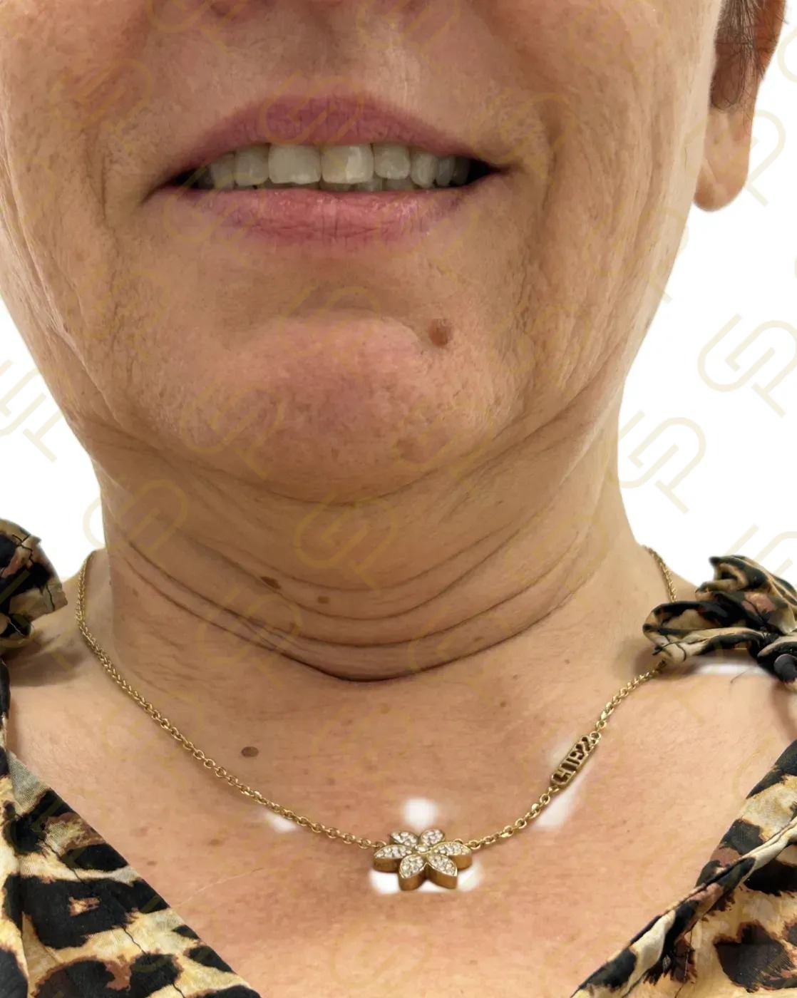 Deep facelift a deep necklift - dramatická konturace krku