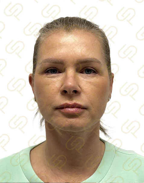 Deep plane facelift a deep necklift - přirozené omlazení obličeje a krku