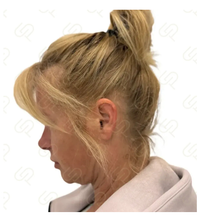 Deep plane facelift a deep necklift - přirozené omlazení obličeje a krku