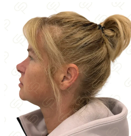 Deep plane facelift a deep necklift - přirozené omlazení obličeje a krku