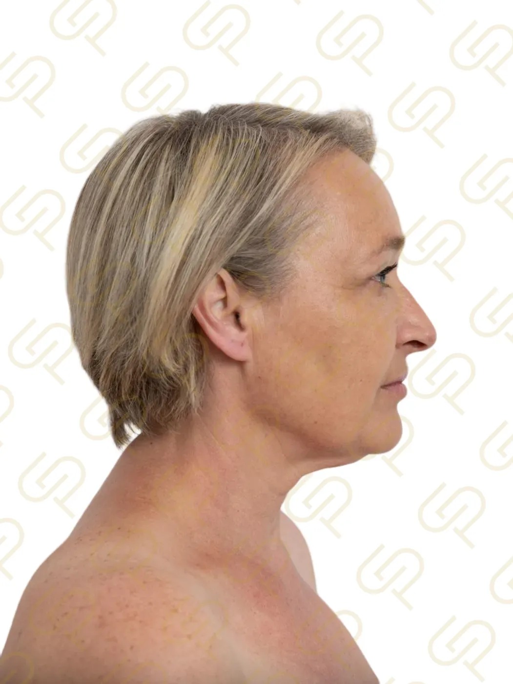 Deep plane facelift a deep necklift - naprosto přirozená proměna