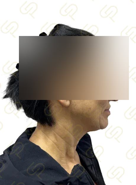 Deep plane facelift a deep necklift - přirozená proměna