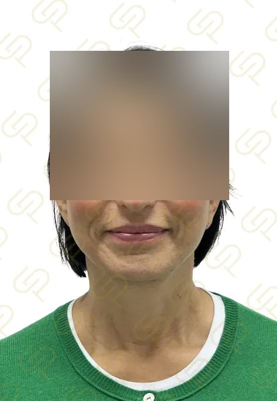 Deep plane facelift a deep necklift - přirozená proměna