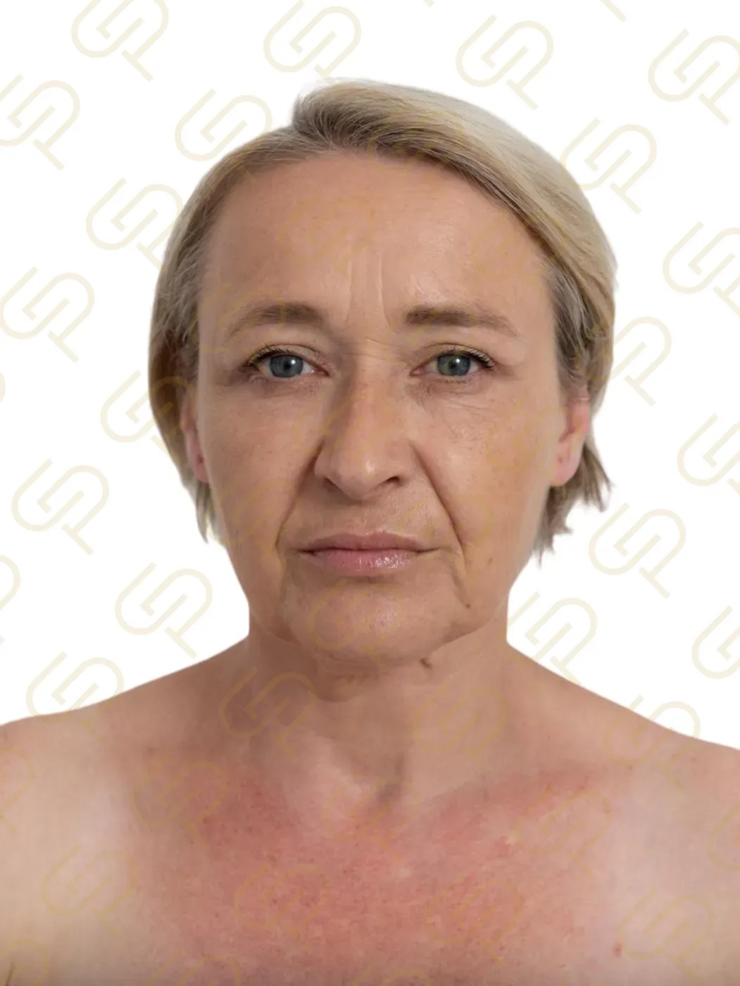 Deep plane facelift a deep necklift - naprosto přirozená proměna